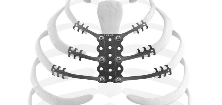 Sternal reconstruction