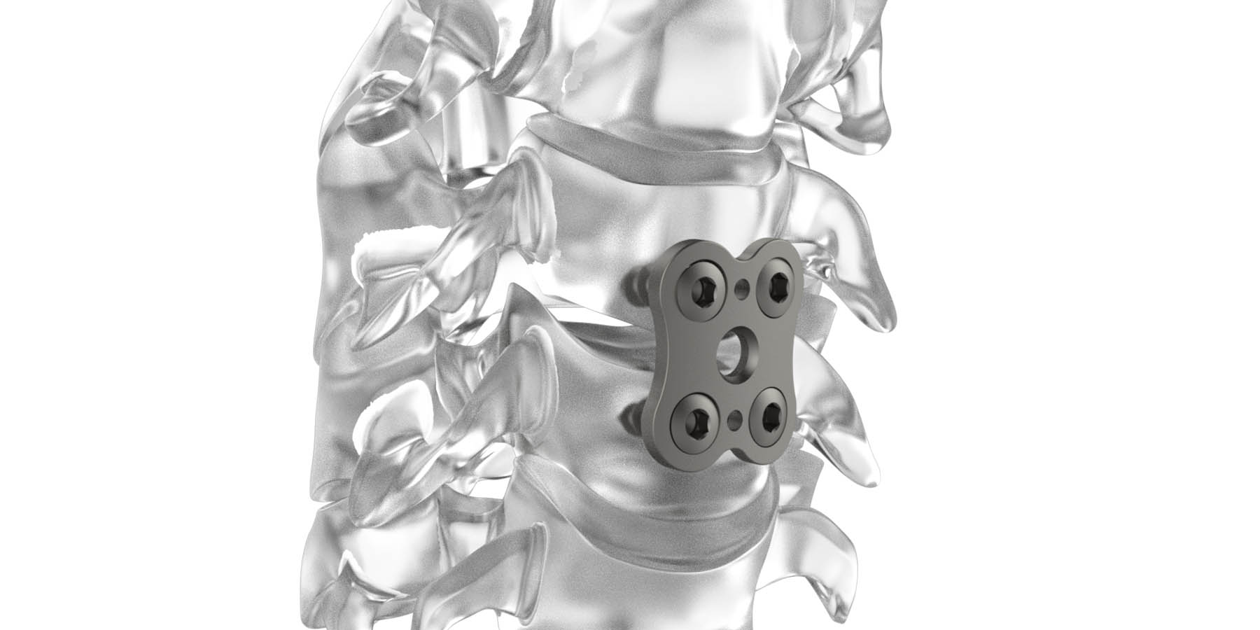 Plates for Anterior Cervical Arthrodesis